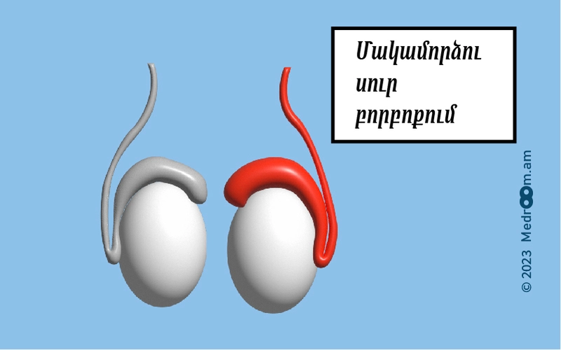 Մակամորձու սուր բորբոքում